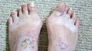 Can Bunions Return After Lapiplasty? Exploring Long-Term Results and Expectations